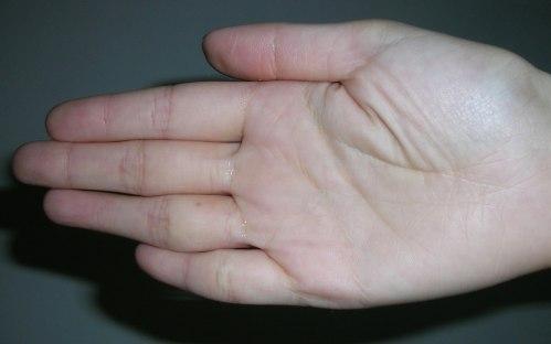 手指震颤:两手抖动,不能作精细工作,细震颤常见于甲亢症;中震颤见于